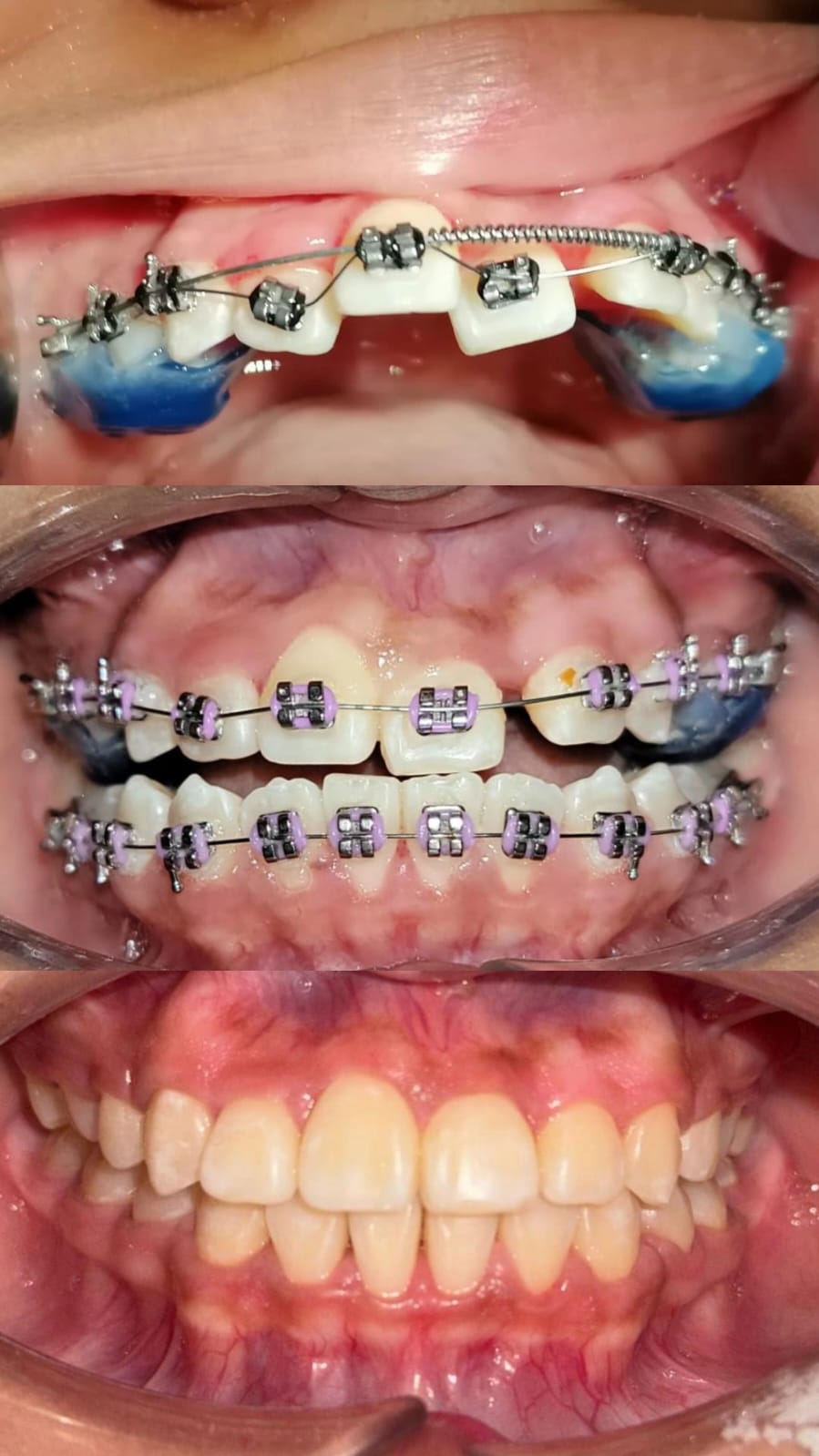 Brackets dentales